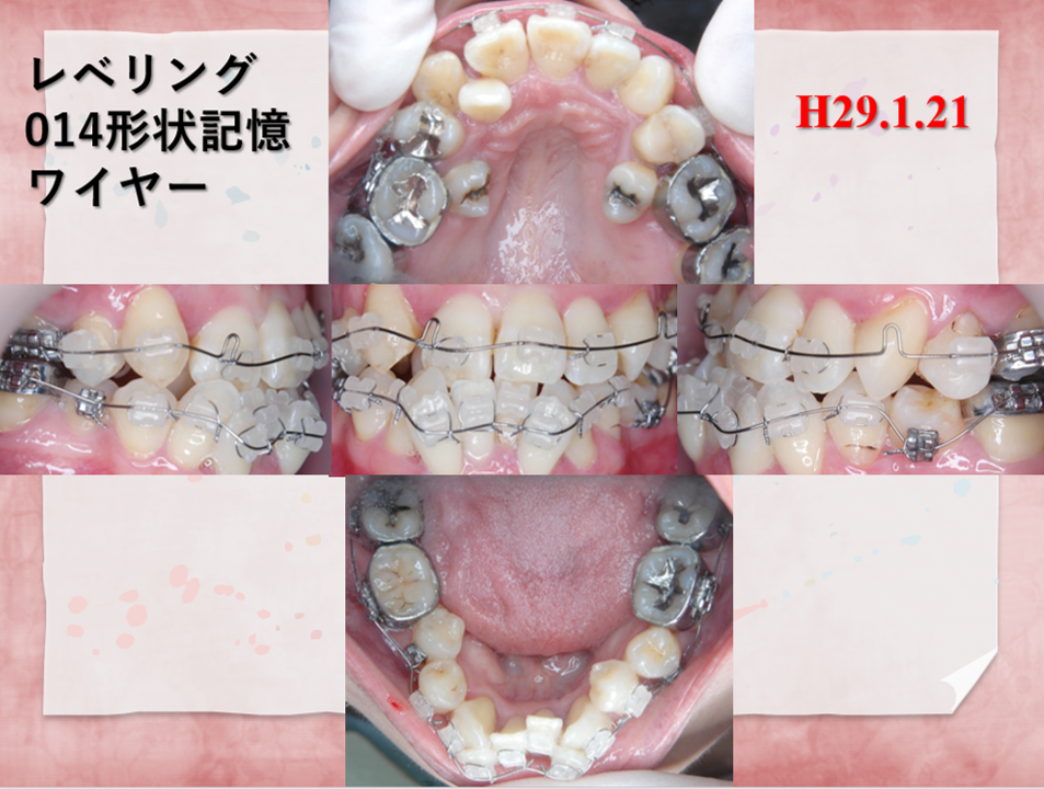 39歳女性途中１
