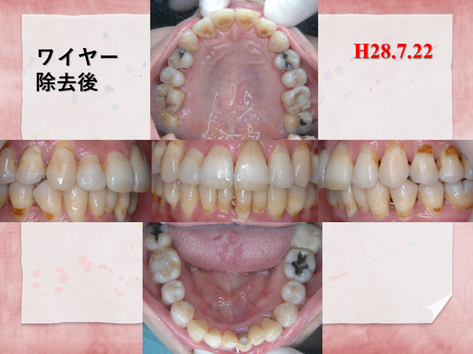 54歳女性後