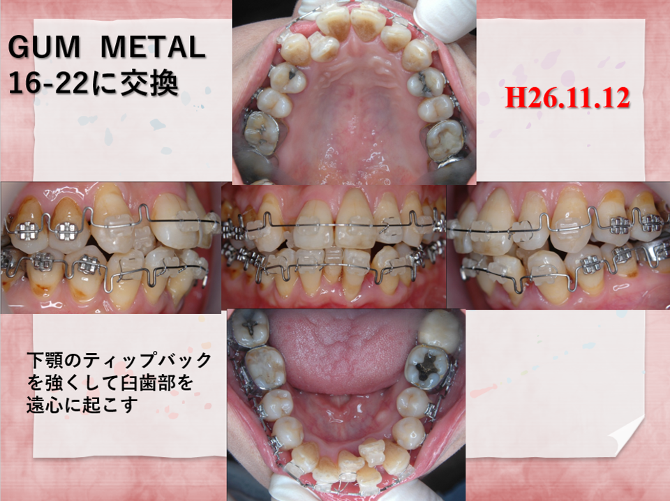 54歳女性途中1