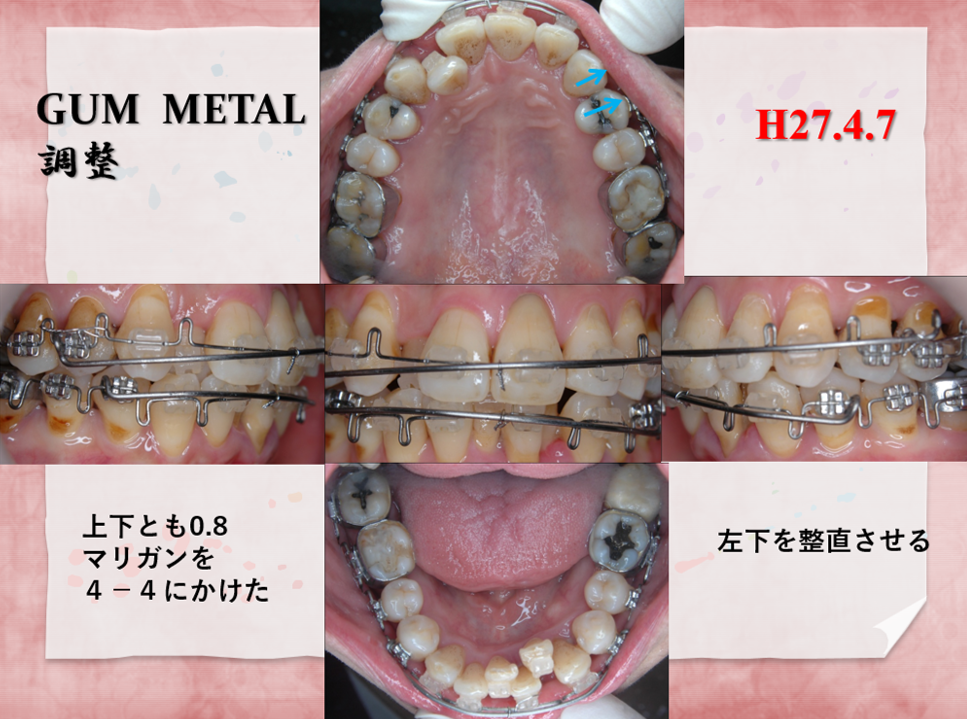 54歳女性途中2