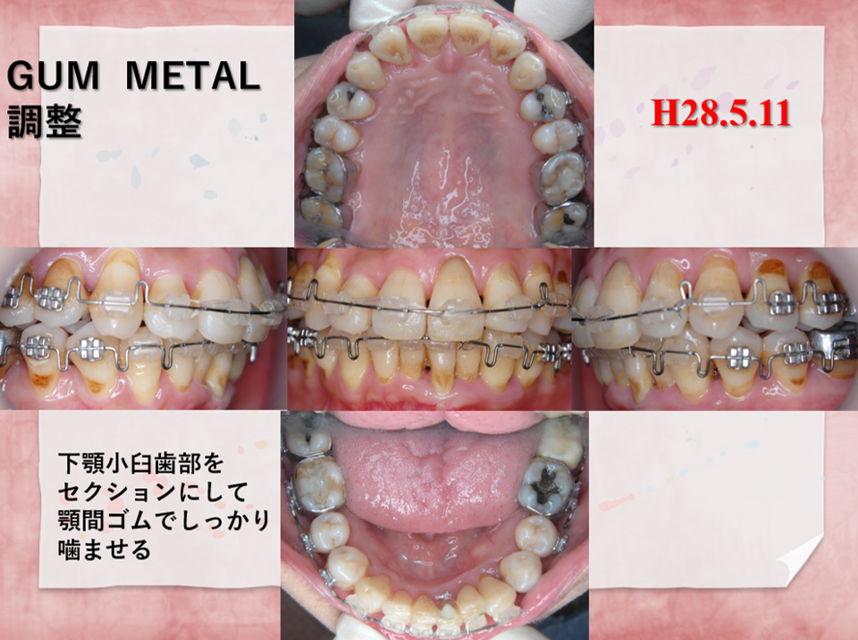 54歳女性途中3
